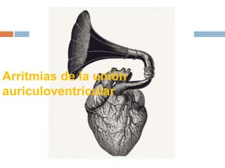 Arritmias de la unión
auriculoventricular
 