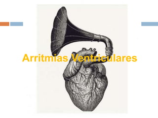 Arritmias Ventriculares
 