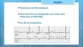 Mobitz I
! Fenómeno de Wenckebach.
! Intervalo PR se va alargando con cada ciclo
hasta que un QRS falta.
! Los RR son irregulares.
 