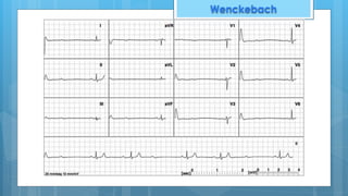 Wenckebach
 