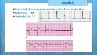 Mobitz II
! Intervalo P-R es constante, existen ondas P no conducidas
! Fijo: 2:1; 3:1; 4:1
! Variable: 4:1; 3:1
 