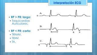 ▪ RP > PR: largo:
▪ Taquicardias
Auriculares.
▪ RP < PR: corto:
▪ TRNAV.
▪ TRAV.
▪ TA.
Interpretación ECG
 