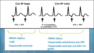 -TRNAV típica
-Taquicardia ortodrómica por HPE
-Taquicardia auricular con BAV 1er
grado
-TRNAV atípica
- PJRT
-Taquicardia auricular
Con RP cortoCon RP largo
 