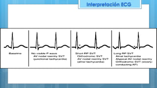 Interpretación ECG
 