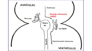 Periodo refractario
LARGO
 