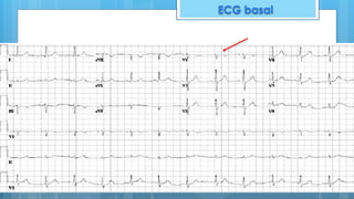 ECG basal
 