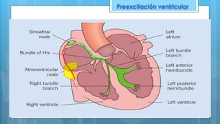 Preexcitación ventricular
 