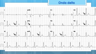 Sd. Wolff Parkinson White
Onda delta
 