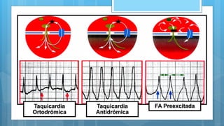 Taquicardia
Ortodrómica
Taquicardia
Antidrómica
FA Preexcitada
 