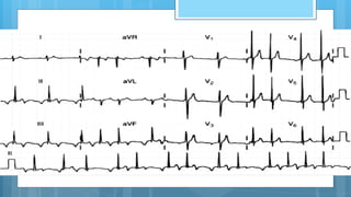 Taquicardia auricular
 