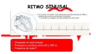 Arritmias | PDF