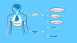 Bradiarritmia
Bloqueo
AV
Alto grado
1°, 2°, 3°
Sinusal
Paro sinusal
Bradicardia sinusal
Sx. seno enfermo
 