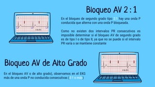 Bloqueo AV 2 : 1
En el bloqueo AV o de alto grado), observamos en el EKG
más de una onda P no conducida consecutivas (3:1 o más)
Bloqueo AV de Alto Grado
En el bloqueo de segundo grado tipo 2:1 hay una onda P
conducida que alterna con una onda P bloqueada.
Como no existen dos intervalos PR consecutivos es
imposible determinar si el bloqueo AV de segundo grado
es de tipo I o de tipo II, ya que no se puede si el intervalo
PR varía o se mantiene constante
 