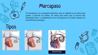 Marcapaso
Un marcapasos es un pequeño dispositivo que se implanta en el pecho para
ayudar a controlar los latidos. Se utiliza para evitar que el corazón lata
demasiado lento. La implantación de un marcapasos en el pecho requiere un
procedimiento quirúrgico.
Biventricular
Tipos
 