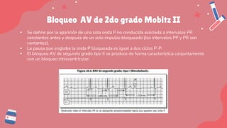 Bloqueo AV de 2do grado Mobitz II
▪ Se define por la aparición de una sola onda P no conducida asociada a intervalos PR
constantes antes y después de un solo impulso bloqueado (los intervalos PP y PR son
contantes).
▪ La pausa que engloba la onda P bloqueada es igual a dos ciclos P-P.
▪ El bloqueo AV de segundo grado tipo II se produce de forma característica conjuntamente
con un bloqueo intraventricular.
 