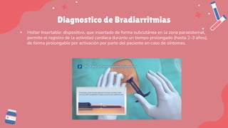 Diagnostico de Bradiarritmias
▪ Holter Insertable: dispositivo, que insertado de forma subcutánea en la zona paraesternal,
permite el registro de la actividad cardiaca durante un tiempo prolongado (hasta 2-3 años),
de forma prolongable por activación por parte del paciente en caso de síntomas.
 