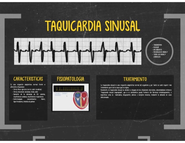 Arritmias Guillermo Stella