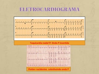 Taquicardia nodal Onda P invertida
Flutter->acidentes substituindo onda P
 