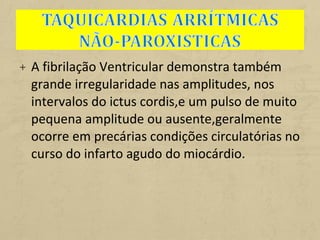 + A fibrilação Ventricular demonstra também
grande irregularidade nas amplitudes, nos
intervalos do ictus cordis,e um pulso de muito
pequena amplitude ou ausente,geralmente
ocorre em precárias condições circulatórias no
curso do infarto agudo do miocárdio.
 