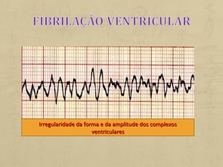 Irregularidade da forma e da amplitude dos complexosIrregularidade da forma e da amplitude dos complexos
ventricularesventriculares
 