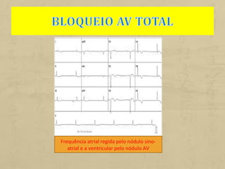 Frequência atrial regida pelo nódulo sino-
atrial e a ventricular pelo nódulo AV
 