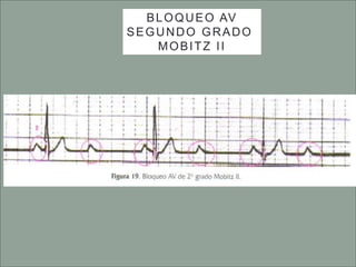 BLOQUEO AV
SEGUNDO GRADO
MOBITZ II
 