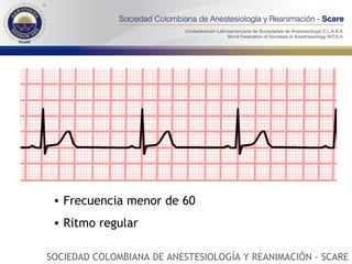 Frecuencia menor de 60 Ritmo regular SOCIEDAD COLOMBIANA DE ANESTESIOLOGÍA Y REANIMACIÓN - SCARE 