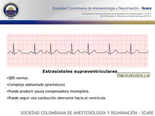 QRS normal. Complejo adelantado (prematuro) Puede producir pausa compensadora incompleta. Puede seguir una conducción aberrante hacia el ventrículo  SOCIEDAD COLOMBIANA DE ANESTESIOLOGÍA Y REANIMACIÓN - SCARE 
