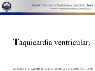 T aquicardia ventricular.  SOCIEDAD COLOMBIANA DE ANESTESIOLOGÍA Y REANIMACIÓN - SCARE 