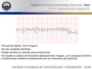 Frecuencia rápida: ritmo irregular. No hay complejos definidos.  Puede terminar en asistolia como evento final. El trazado es caótico de frecuencia absolutamente irregular, con complejos de forma y amplitud que cambian incesantemente por las variaciones del potencial. SOCIEDAD COLOMBIANA DE ANESTESIOLOGÍA Y REANIMACIÓN - SCARE 