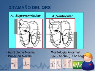 3.TAMAÑO DEL QRS
A. Supraventricular
• Morfología Normal
• Duración Normal
A. Ventricular
• Morfología Anormal
• QRS Ancho ( 0,12 seg)
 