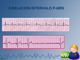 5.RELACION INTERVALO P-QRS
 