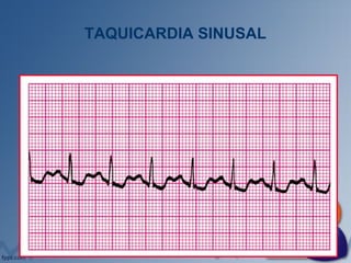 TAQUICARDIA SINUSAL
 