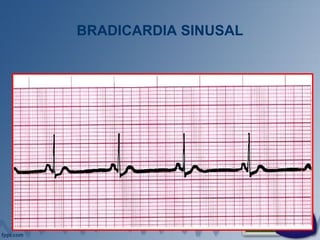 BRADICARDIA SINUSAL
 