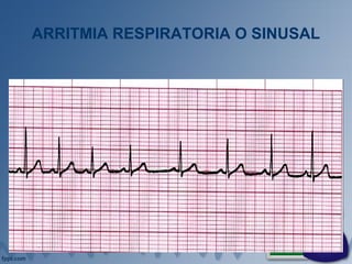 ARRITMIA RESPIRATORIA O SINUSAL
 