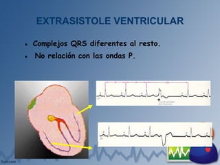 EXTRASISTOLE VENTRICULAR
● Complejos QRS diferentes al resto.
● No relación con las ondas P.
 