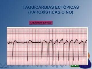 TAQUICARDIAS ECTÓPICAS
(PAROXÍSTICAS O NO)
Taquicardia auricularTaquicardia auricular
 