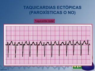 TAQUICARDIAS ECTÓPICAS
(PAROXÍSTICAS O NO)
Taquicardia nodalTaquicardia nodal
 