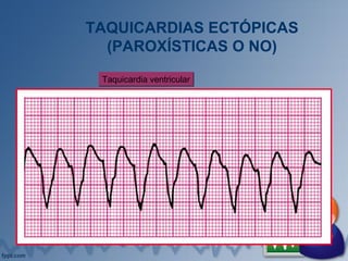 TAQUICARDIAS ECTÓPICAS
(PAROXÍSTICAS O NO)
Taquicardia ventricularTaquicardia ventricular
 
