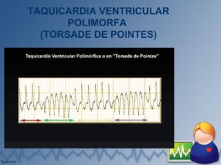 TAQUICARDIA VENTRICULAR
POLIMORFA
(TORSADE DE POINTES)
 