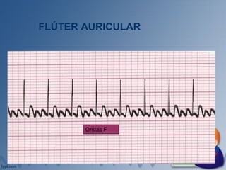 FLÚTER AURICULAR
Ondas FOndas F
 