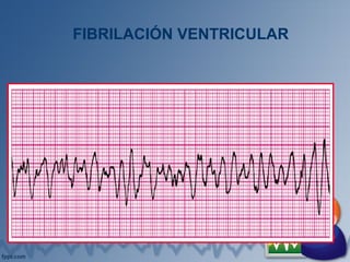 FIBRILACIÓN VENTRICULAR
 