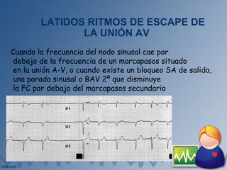 LATIDOS RITMOS DE ESCAPE DE
LA UNIÓN AV
Cuando la frecuencia del nodo sinusal cae por
debajo de la frecuencia de un marcapasos situado
en la unión A-V, o cuando existe un bloqueo SA de salida,
una parada sinusal o BAV 2º que disminuye
la FC por debajo del marcapasos secundario
 
