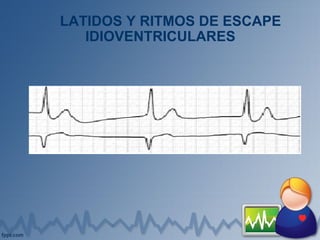 LATIDOS Y RITMOS DE ESCAPE
IDIOVENTRICULARES
 