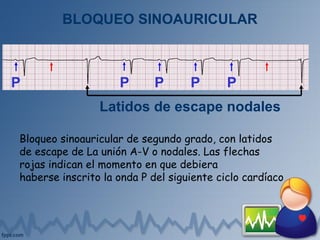 BLOQUEO SINOAURICULAR
Latidos de escape nodales
P P P P P
Bloqueo sinoauricular de segundo grado, con latidos
de escape de La unión A-V o nodales. Las flechas
rojas indican el momento en que debiera
haberse inscrito la onda P del siguiente ciclo cardíaco
 