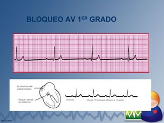 BLOQUEO AV 1ER
GRADO
 