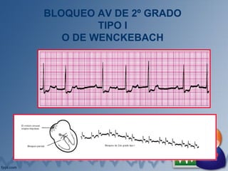BLOQUEO AV DE 2º GRADO
TIPO I
O DE WENCKEBACH
 