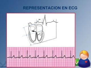 REPRESENTACION EN ECG
 