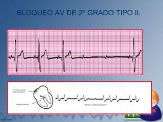 BLOQUEO AV DE 2º GRADO TIPO II.
 