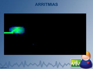 ARRITMIAS
 